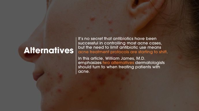 two alternatives for acne treatment