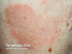 GX-03 Phase 2 Program Expands to Full Atopic Dermatitis Spectrum