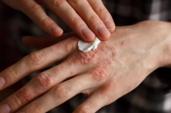 Psoriasis lotion (©TernavskaiaOlgaAlibecShutterstock.com).jpg