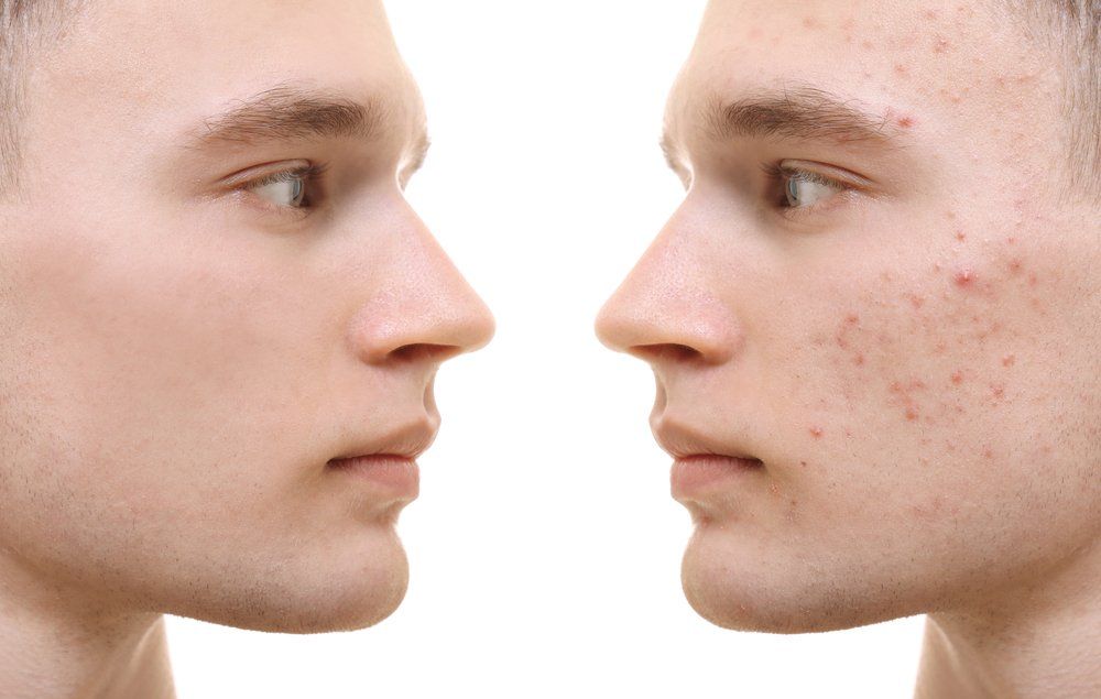 How Men Can Reduce the Visibility of Acne Scarring