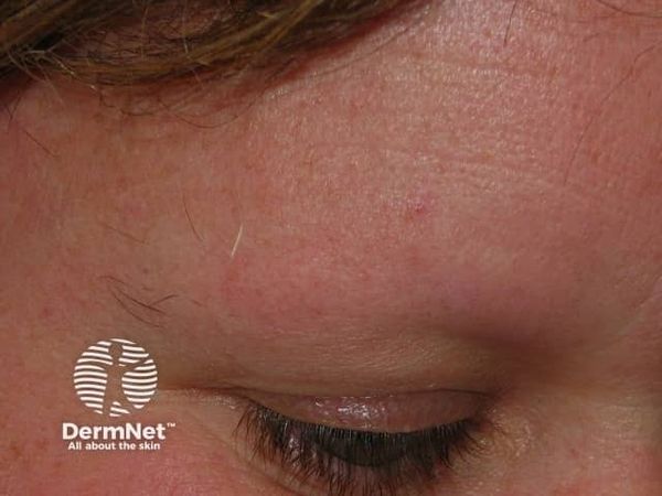 Upadacitinib Receives Positive CHMP Opinion for Severe Alopecia Areata