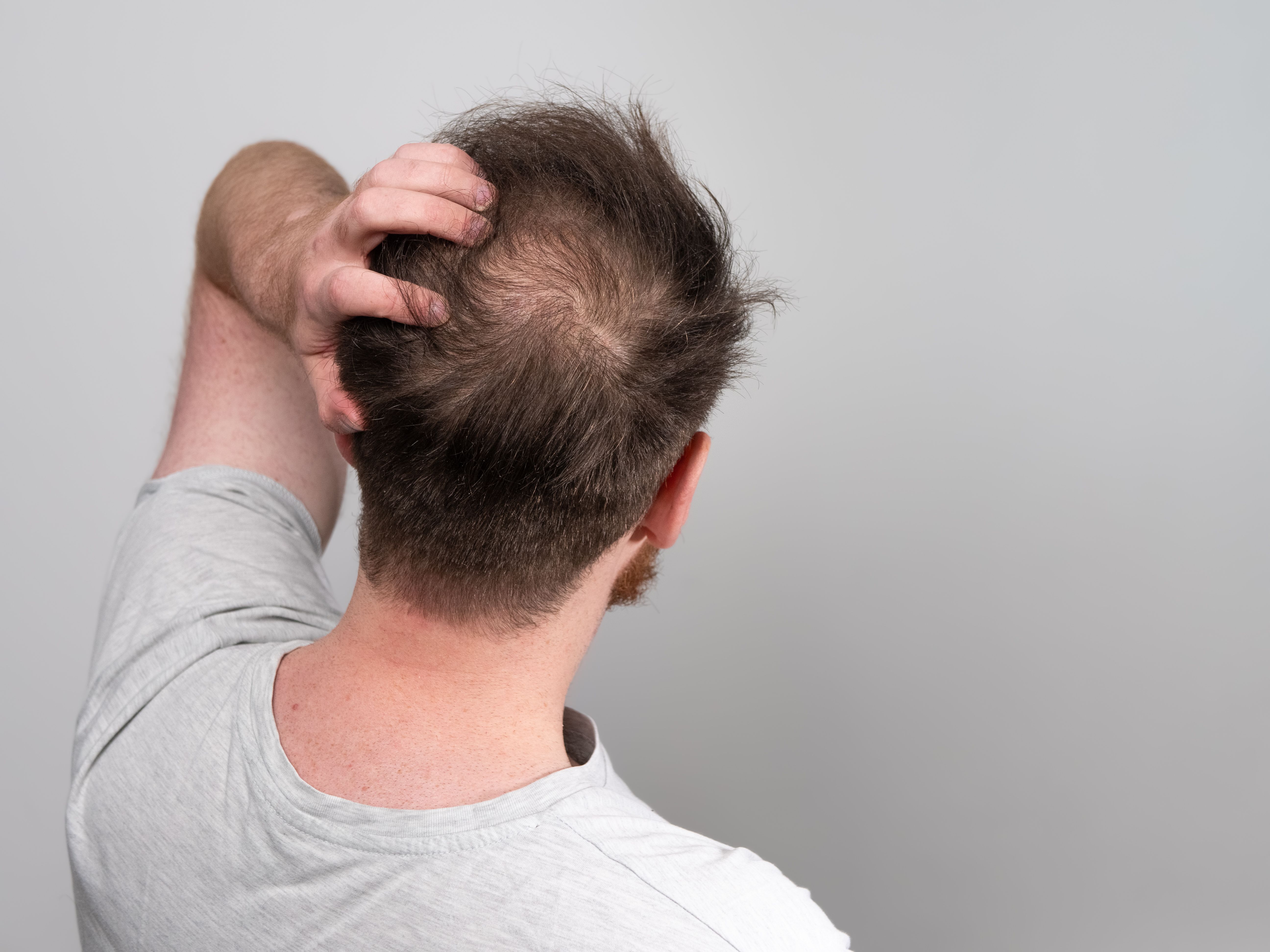 Smoking Cigarettes Associated With Higher Odds of Disease Progression in  Male Pattern Hair Loss