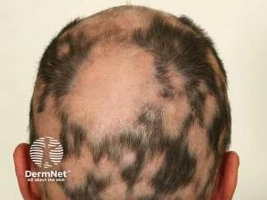 Bempikibart Shows Positive Phase 2a Results in Alopecia Areata