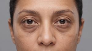 FDA Accepts IND for Injectable rhPDGF-BB in Under-Eye Hollowing