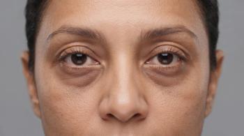 FDA Accepts IND for Injectable rhPDGF-BB in Under-Eye Hollowing