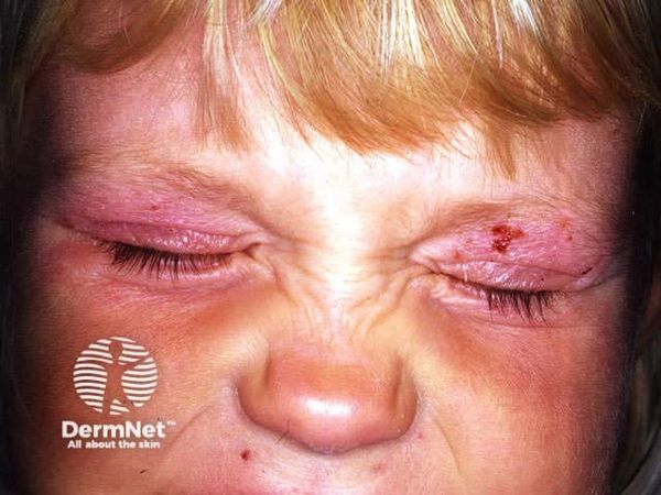 French Early Access Data on Dupilumab in Pediatric Atopic Dermatitis