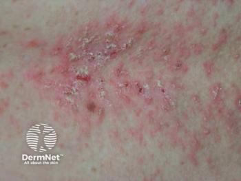 Image Credit: © DermNet