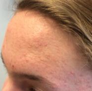 Is It Acne Or Pityrosporum Folliculitis 