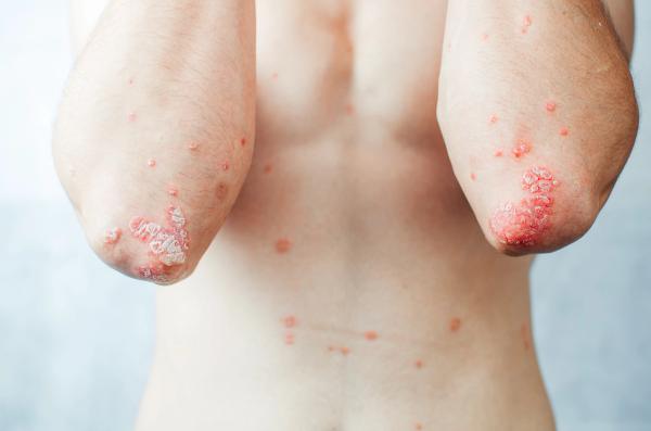 Body Weight, Not BMI, Associated With Brodalumab Response Trajectory in Plaque Psoriasis