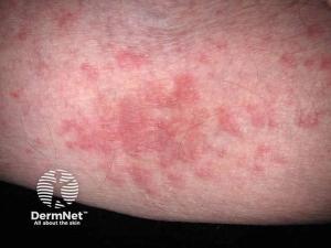 Precision Medicine Arrives in Atopic Dermatitis: Guiding Systemic Treatment Decisions Through Gene Expression Profiling