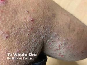 Could Abrocitinib Modify Atopic Dermatitis Disease Course? 