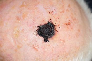 melanoma