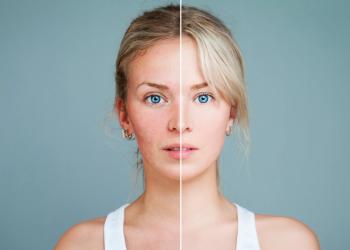 lasers and injectables