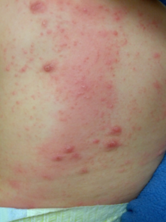 Allergy Rash Scab A Novel Approach to Distinguishing Scabies From Atopic Dermatitis