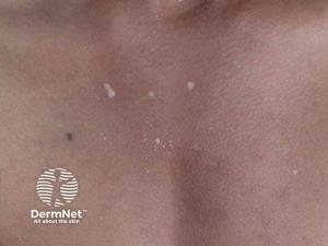 Delgocitinib Advances to Phase 3 Evaluation for Lichen Sclerosus