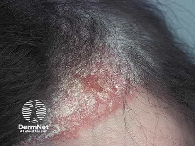 Zasocitinib Shows High Skin Clearance at Hard-to-Treat Psoriasis Sites