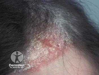 Scalp psoriasis | Image credit: © DermNet