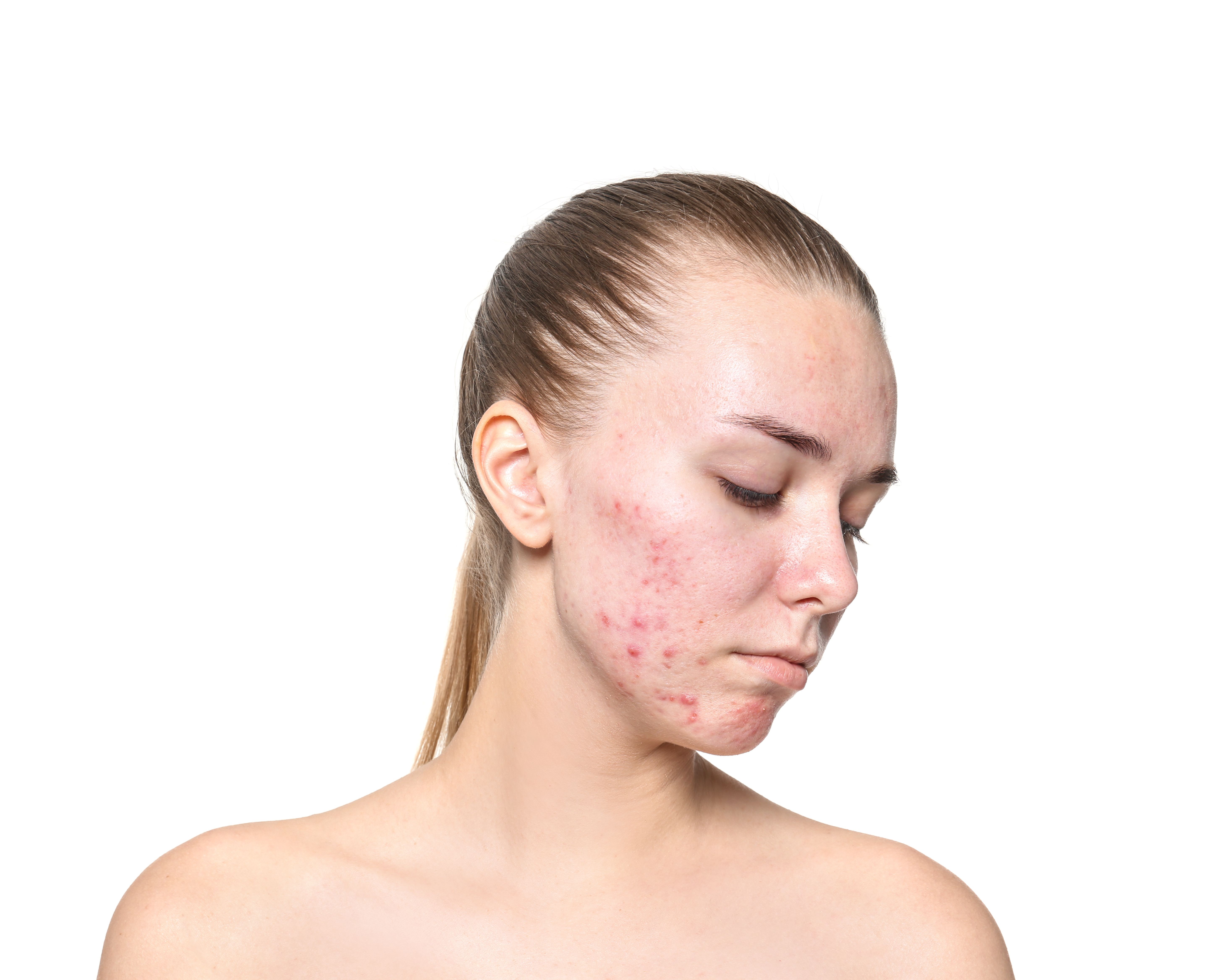 glp 1 eczema GLP-1 Agonists Not Linked to the Development of Acne