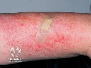 Rese-cel Data Support Registrational Strategy Across Dermatomyositis, Systemic Sclerosis, Lupus 