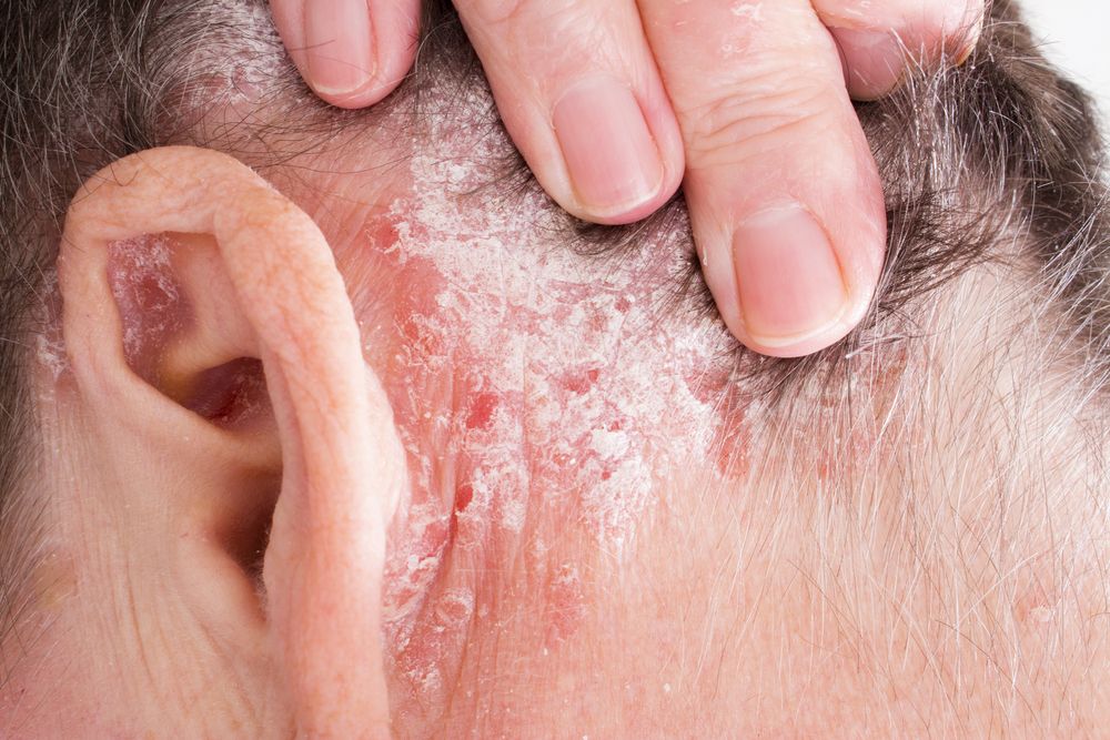 plaque psoriasis behind ears treatment vörös vagy rózsaszín foltok a bőrön