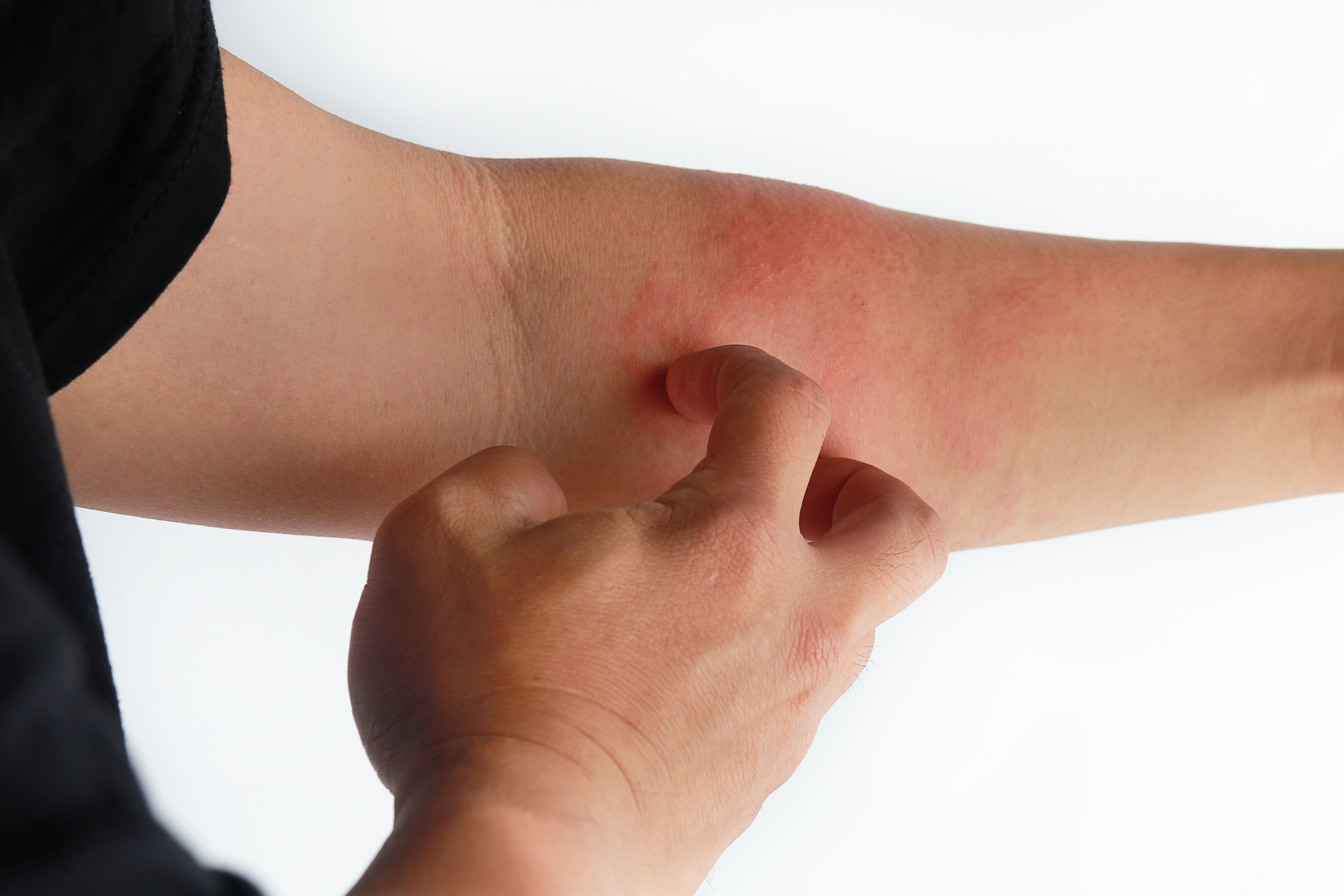 Dupilumab Maintains Long-Term Flare Control Across Dosing Regimens in Atopic Dermatitis