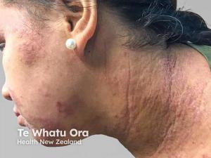 What Counts as “Short-Term” Systemic Corticosteroids in Atopic Dermatitis, and Why It Matters