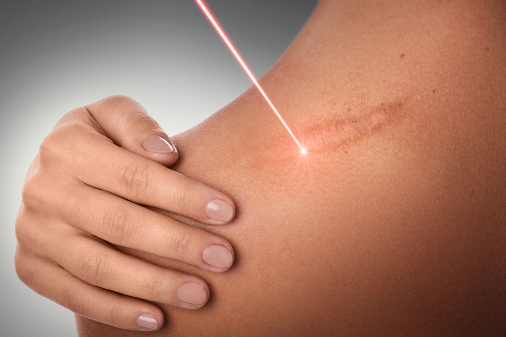 laser scar treatment