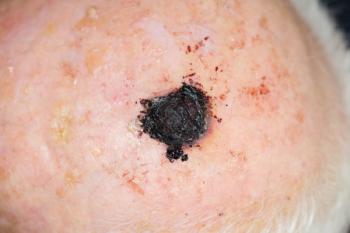 malignant melanoma