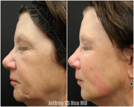 Fat grafting made easier