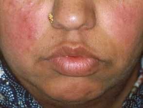 melanotan rosacea Looks Different in Skin of Color Understanding Rosacea: Causes, Triggers &