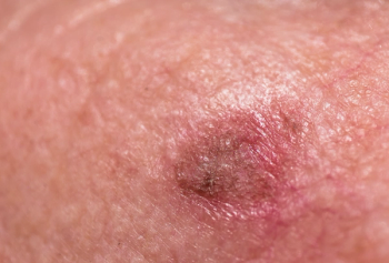 actinic keratoses