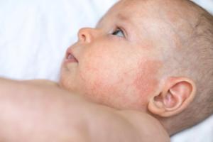 Arcutis Completes Enrollment in Phase 2 Study of Roflumilast Cream for Infant AD