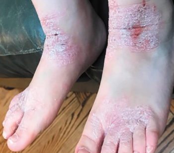 atopic dermatitis feet