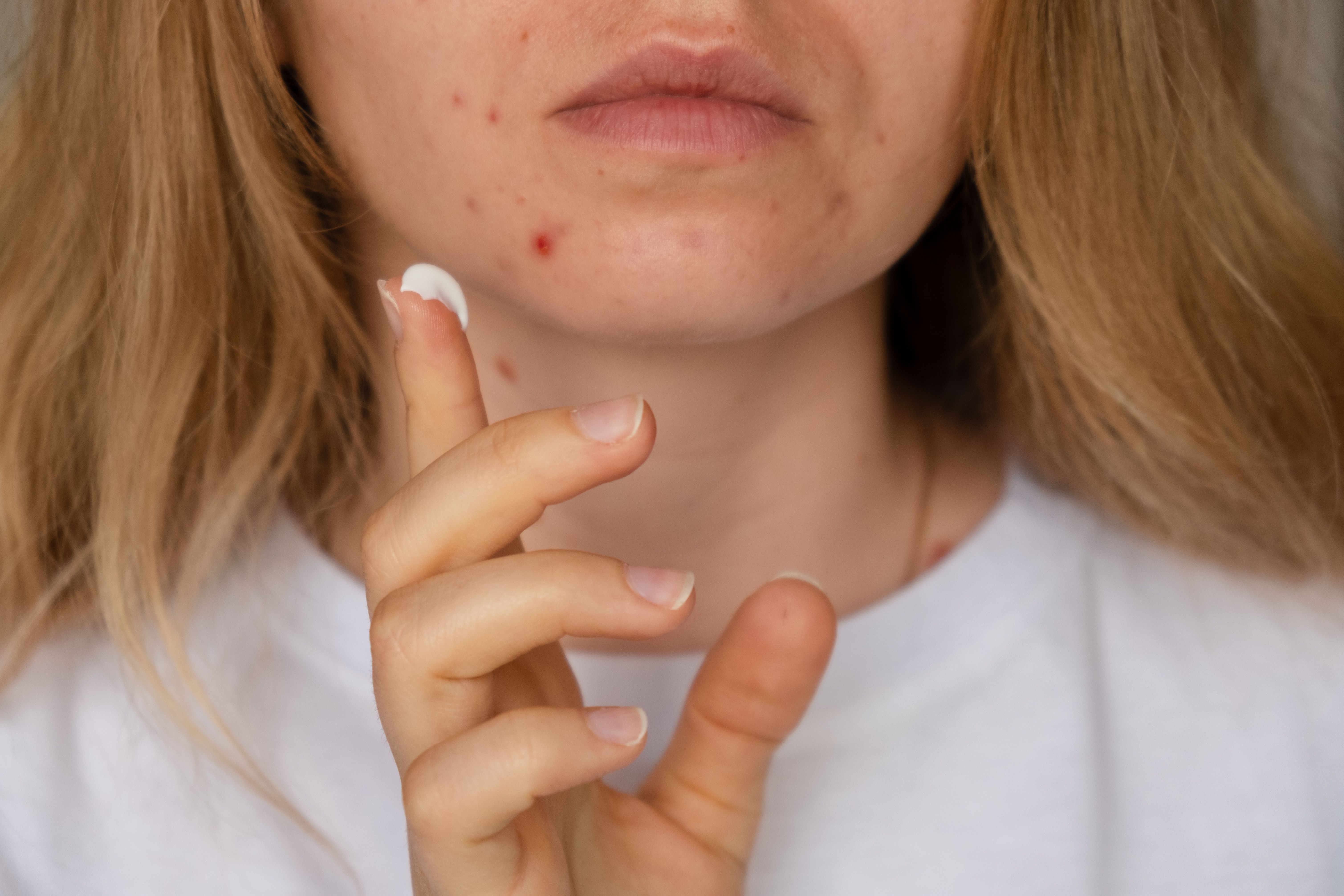 New Insights On the Link Between Comedogenic Cosmetics and Acne