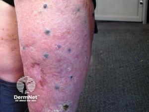 FDA Accepts Third RP1 BLA Resubmission for Advanced Melanoma