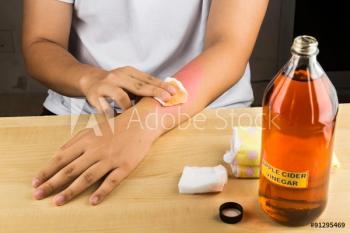 vinegar swap for atopic dermatitis