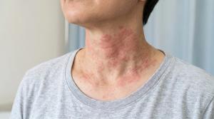 Upadacitinib Shows Broader Inflammatory Effects and Earlier Skin Barrier Restoration Than Dupilumab in Atopic Dermatitis