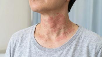 Upadacitinib Shows Broader Inflammatory Effects and Earlier Skin Barrier Restoration Than Dupilumab in Atopic Dermatitis