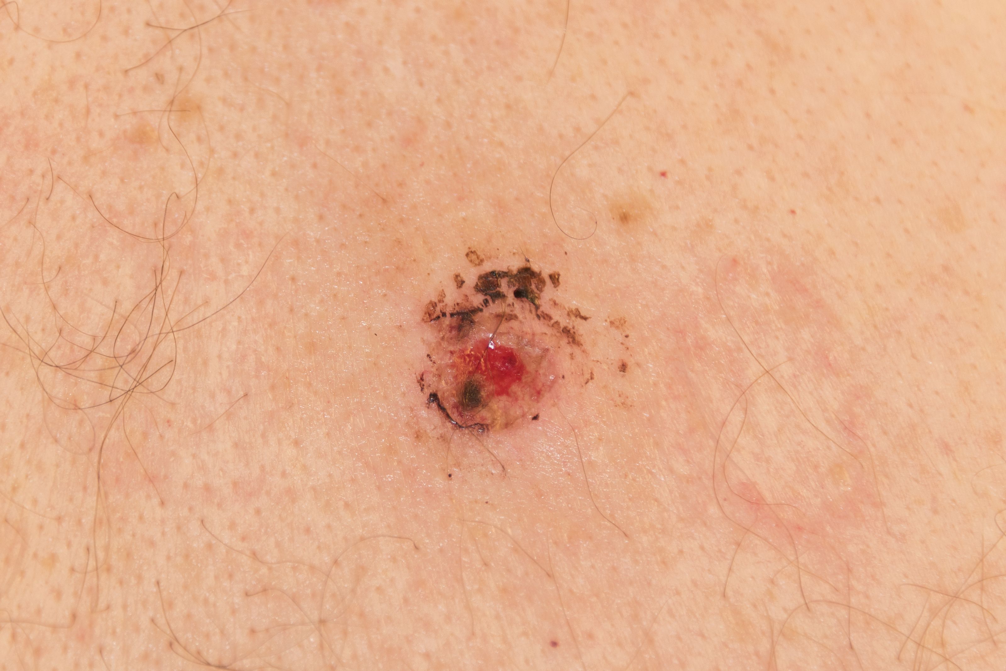 melanoma on skin