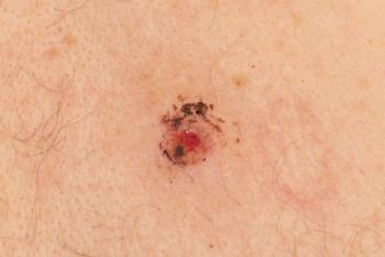 melanoma biopsy