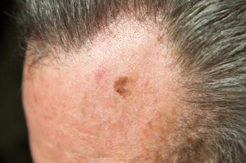 Melanoma in situ on older male forehead