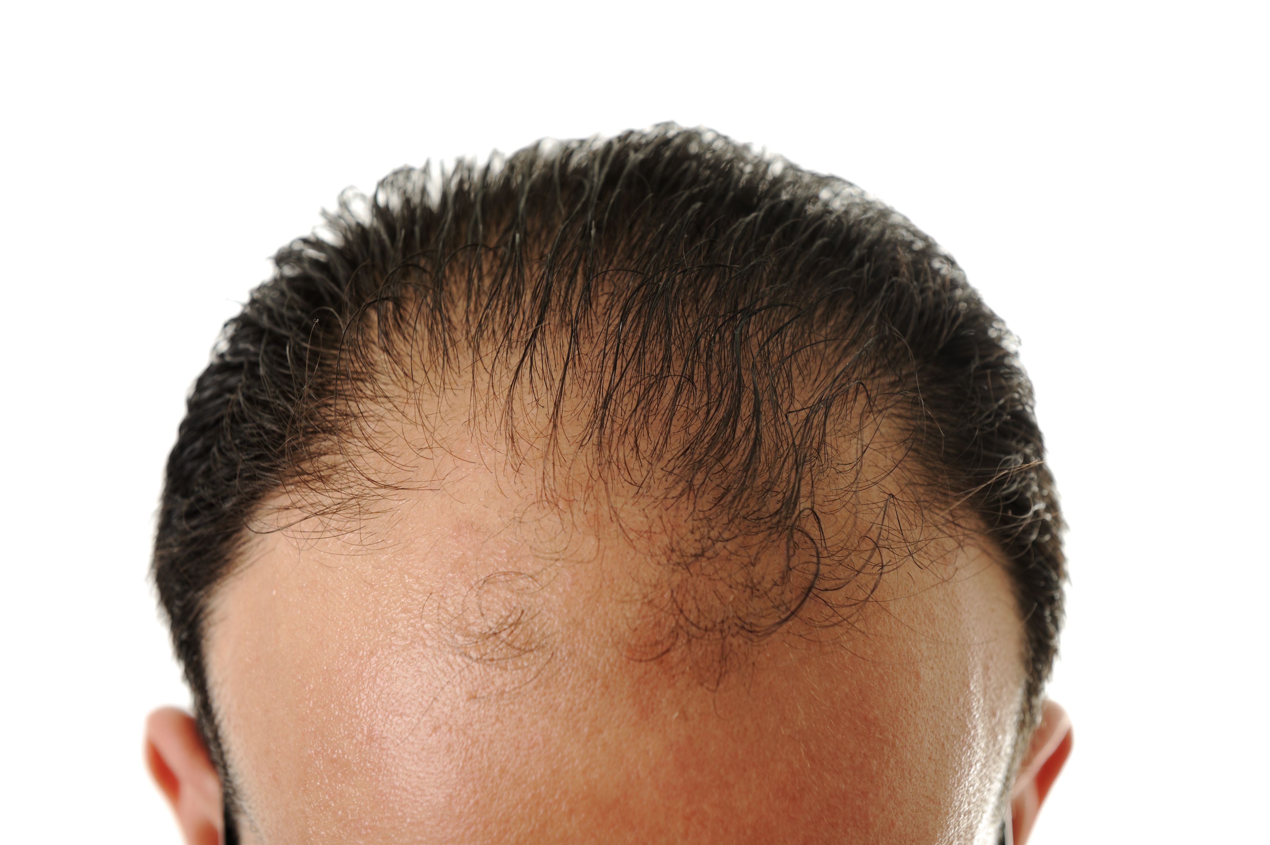 What Is Male Pattern Baldness Types and Causes...(Urdu Hindi) - YouTube