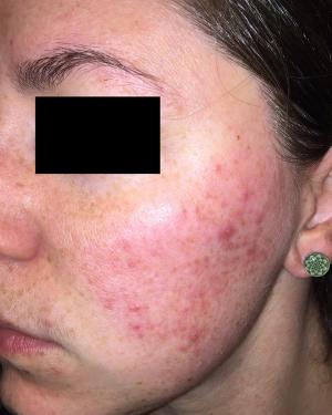 DFD-29 Achieves Phase 3 Co-Primary and All Secondary Endpoints for Papulopustular Rosacea Treatment  