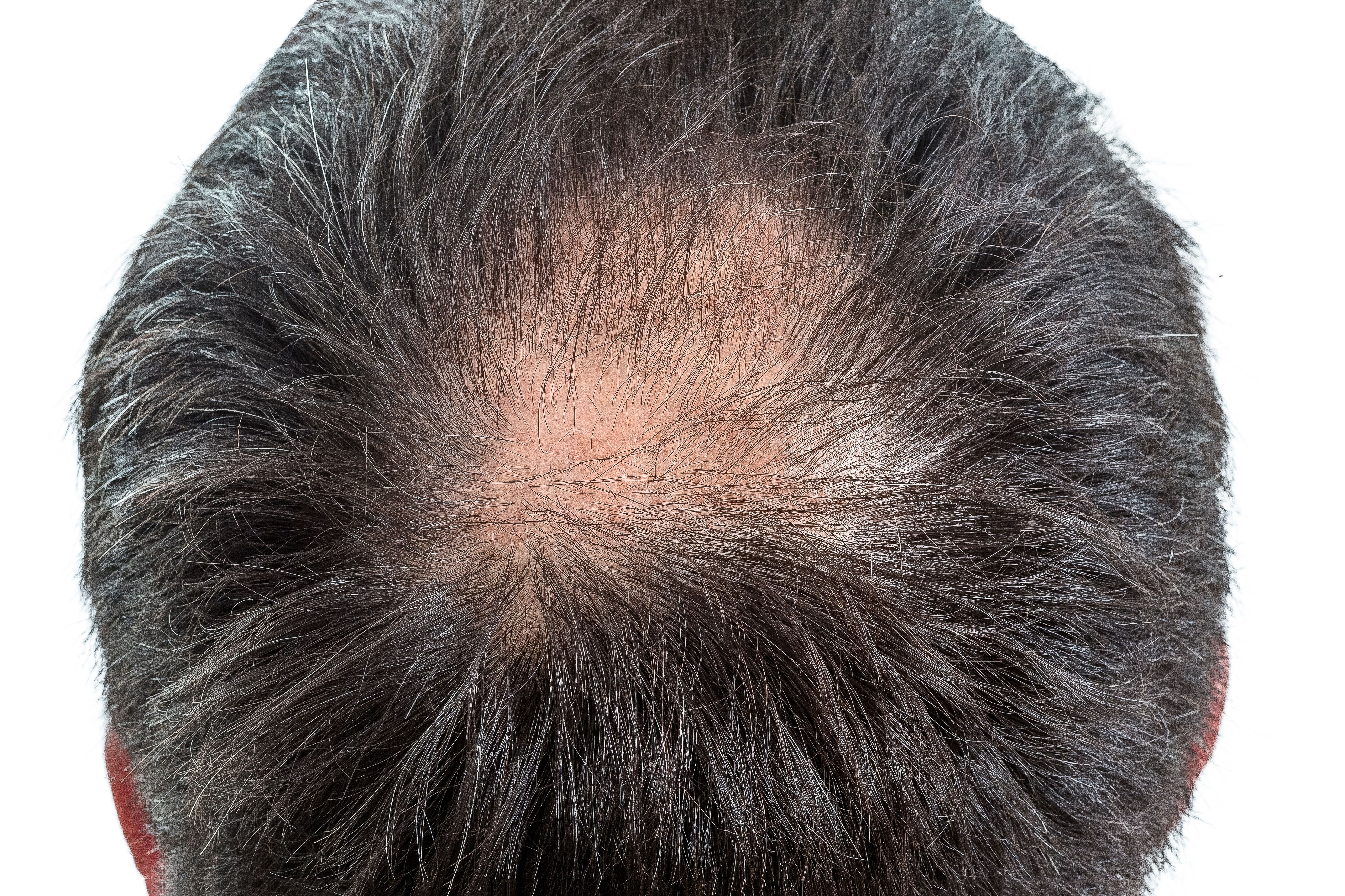 Nutraceutical Supplement Effective and Safe for Male Hair Thinning