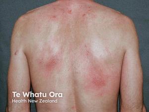 Atopic Dermatitis Associated With Higher Dementia Risk