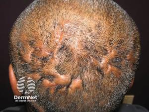 Study Highlights Hidden Inflammation Beyond Visible Lesions in Dissecting Cellulitis of the Scalp