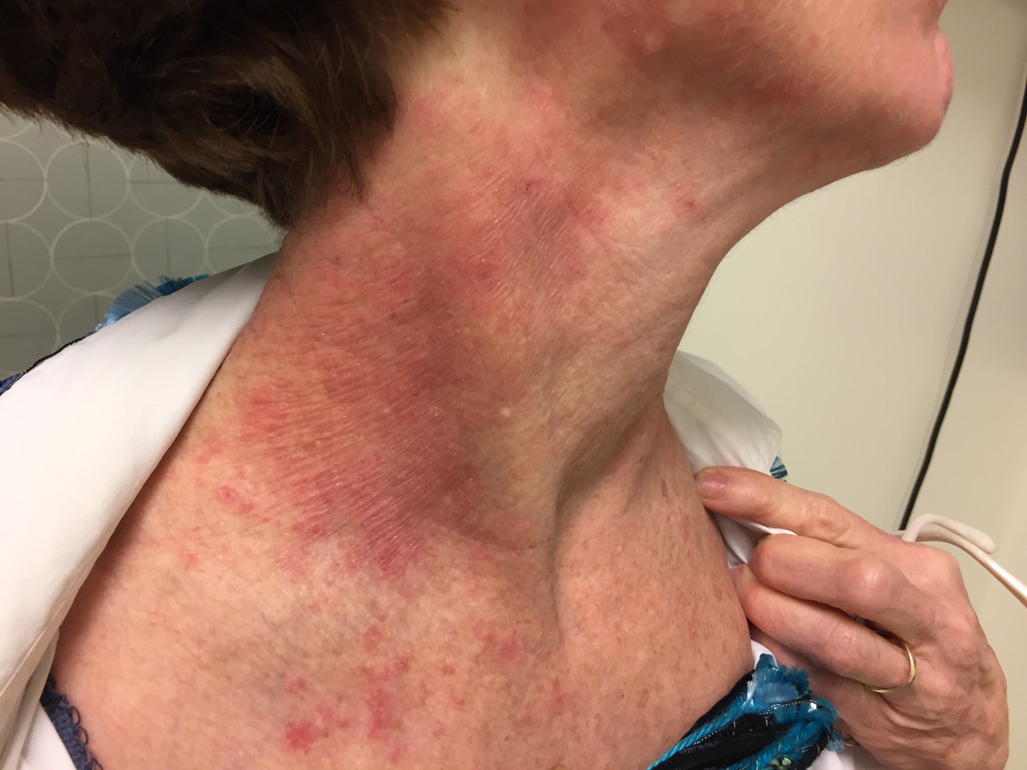 eczema on neck