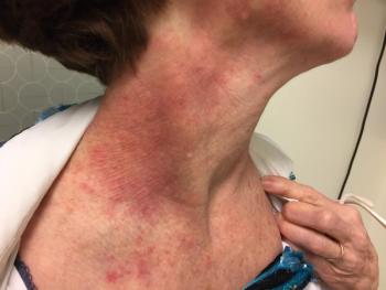 woman atopic dermatitis