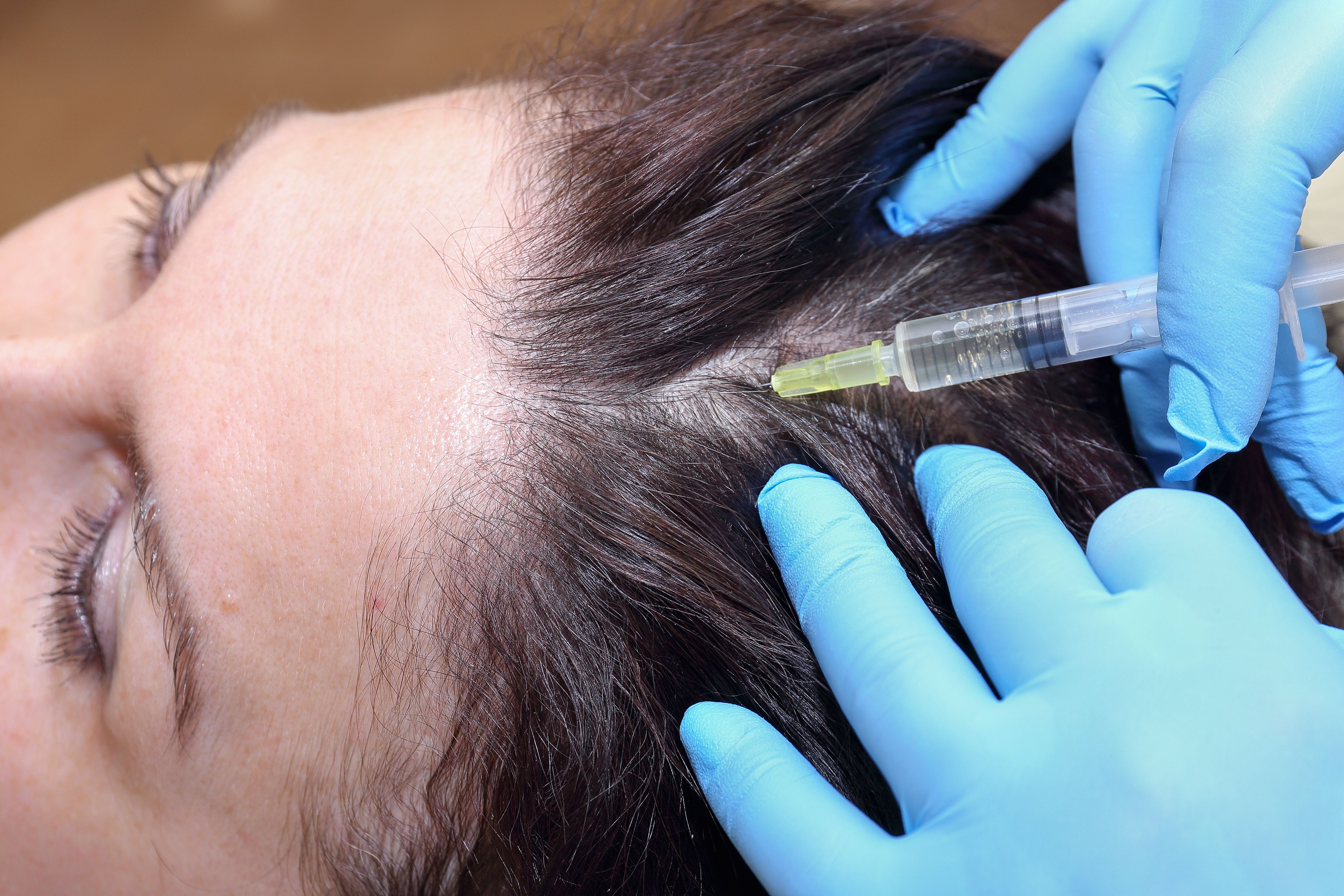Выпадают волосы процедуры. PRP Plasma. Hair treatment мезотерапия. Мезотерапия для волос. Мезотерапия волосистой части головы.