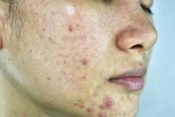acne lesions on face